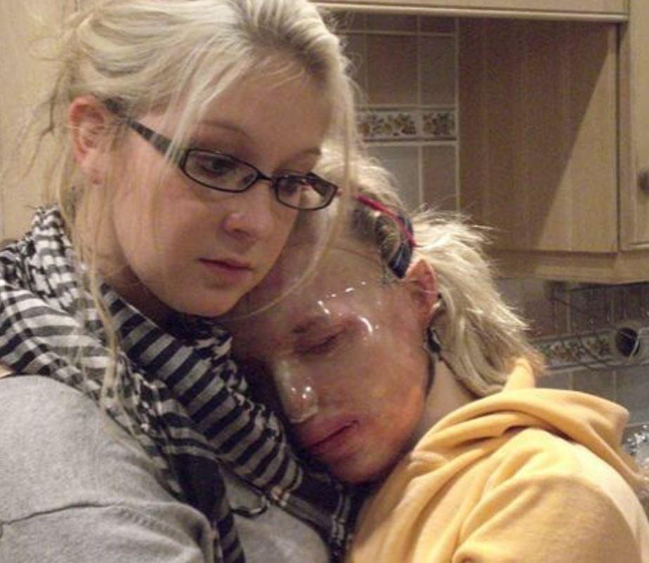 Femeia căreia medicii i-au reconstruit complet chipul după ce fostul iubit a desfigurat-o cu acid. Cum arată acum Katie Piper