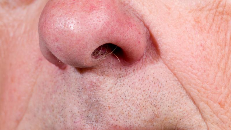 Medicii au extras din nasul unui bărbat de 59 de ani o monedă care se afla acolo de mai bine de jumătate de secol