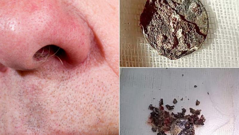 Medicii au extras din nasul unui bărbat de 59 de ani o monedă care se afla acolo de mai bine de jumătate de secol