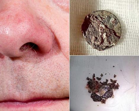 Un bărbat a trăit peste 50 de ani cu o monedă în nas. Cum a ajuns acolo bănuțul și de ce a durat atât să ceară ajutor