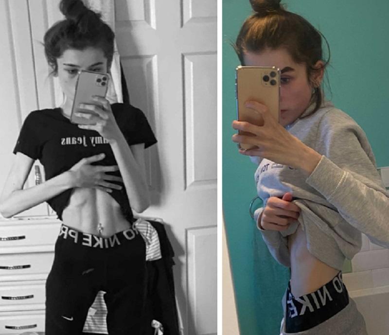 Colaj foto cu Ellie Makin, făcându-și selfie la abdomen, pe vremea când avea anorexie