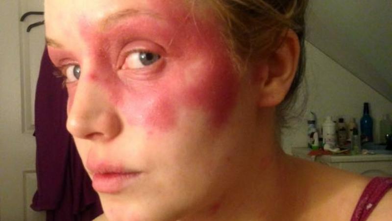 Karina Withers suferă de o boală de piele rară care îi face tenul să sângereze. Cum arată tânără de 29 ani