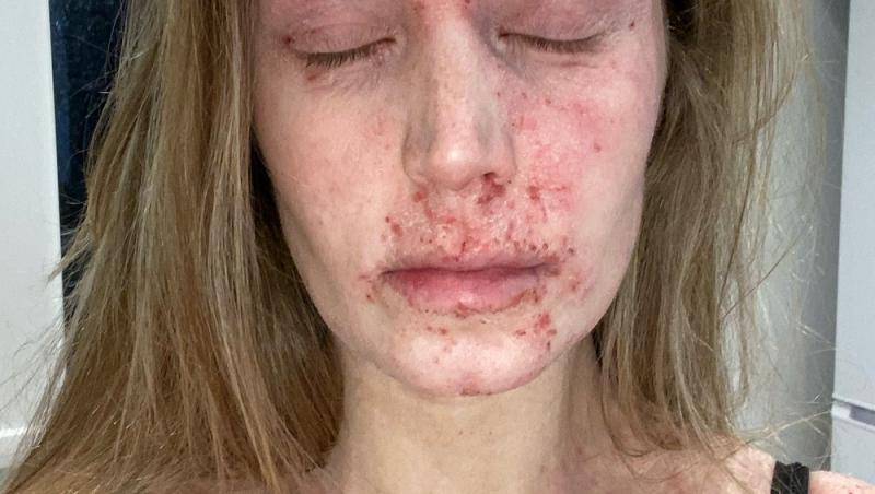 Karina Withers suferă de o boală de piele rară care îi face tenul să sângereze. Cum arată tânără de 29 ani