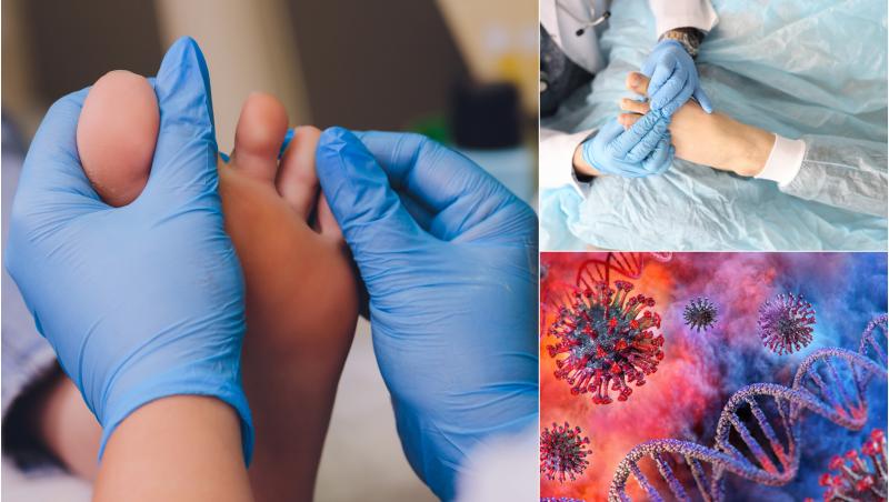 Oamenii de știință au descoperit de ce unele persoane infectate cu virusul SARS-CoV-2 dezvoltă afecțiunea “degete Covid”