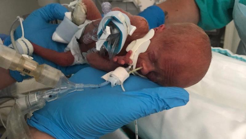 Un bebeluș de 45 grame a supraviețuit datorită fratelui său geamăn. Cum a fost posibil