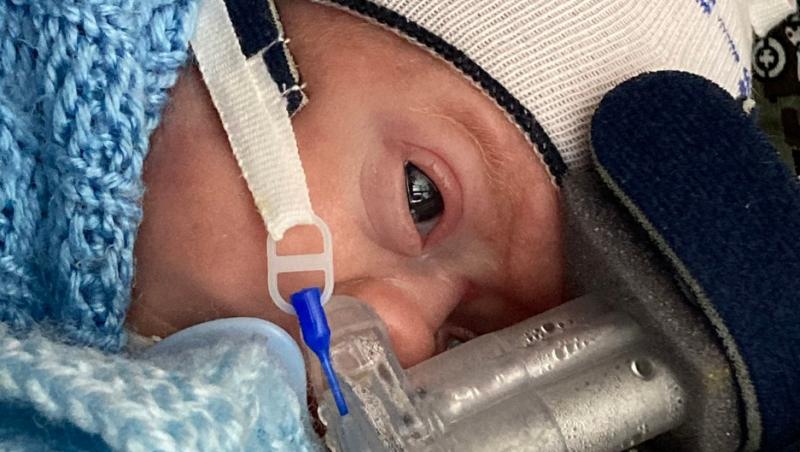 Un bebeluș de 45 grame a supraviețuit datorită fratelui său geamăn. Cum a fost posibil