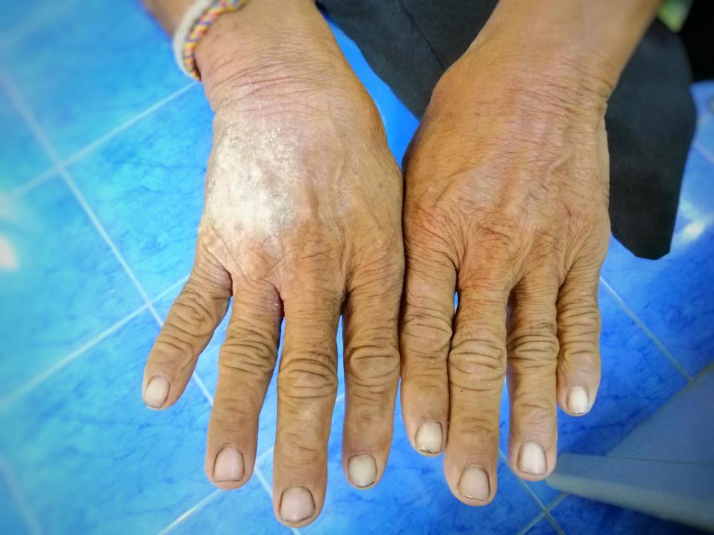 doua maini care au pielea incretita si groasa