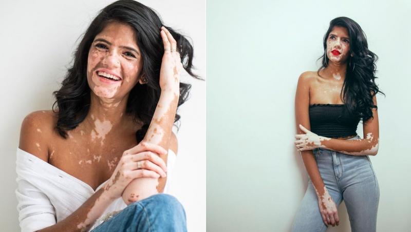 Sonya Danita, o tânără din Kuala Lumpur, Malaysia suferă de o boală rară a pielii. În ciuda afecțiunii sale, Sonya, în vârstă de 28 ani, a devenit model.