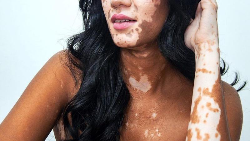Sonya Danita suferă de vitiligo, dar a devenit model. Cum arată tânără. 