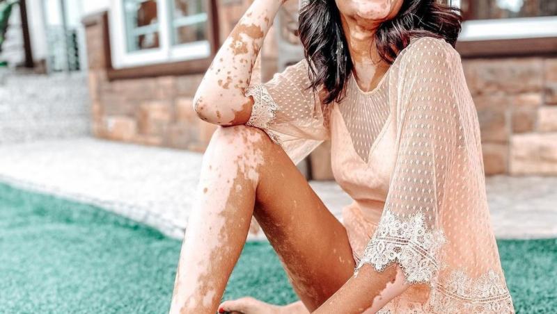 Sonya Danita suferă de vitiligo, dar a devenit model. Cum arată tânără. 
