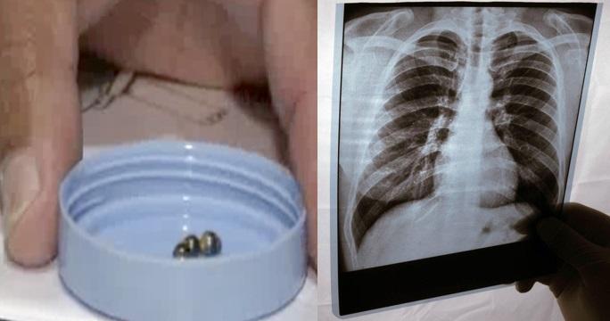 colaj foto: magneți ținuți între degete (stânga) și o ecografie medicală (dreapta)