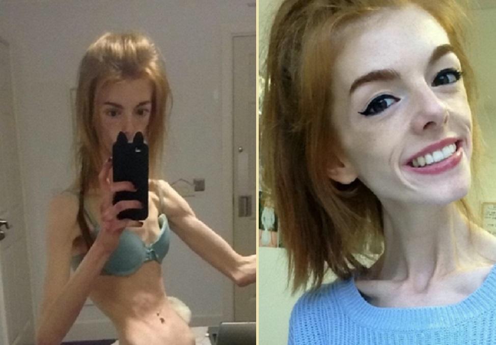 colaj foto: Annie Windley, poză în care își arată abdomenul, când avea 28 kilograme (stânga) și selfie cu ea (dreapta)