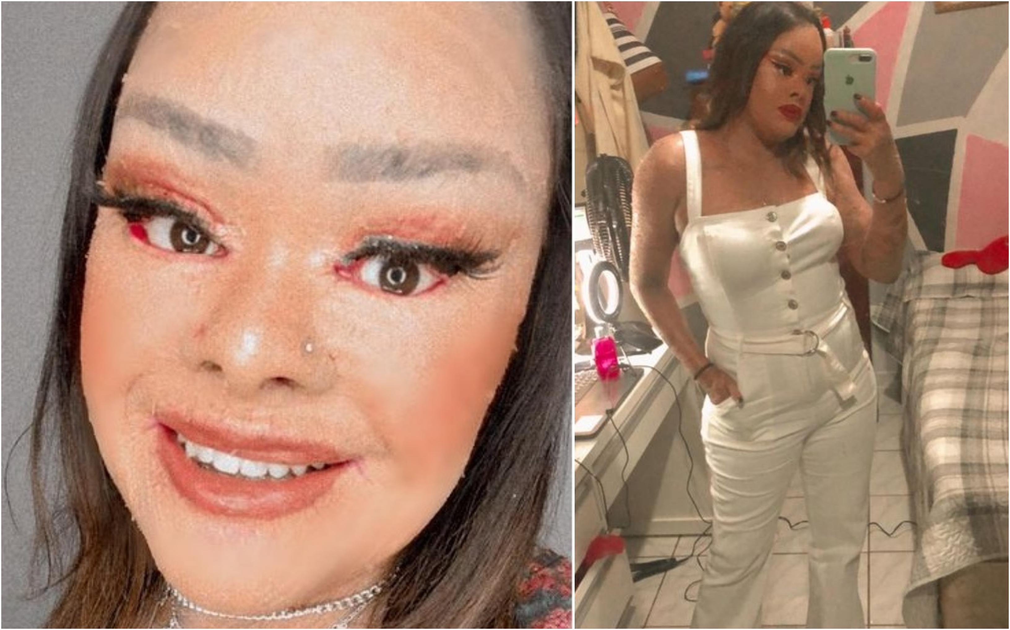 Pielea Palomei Lira nu are tratament nicăieri &icirc;n lume. De ce arată așa fața tinerei de 23 de ani