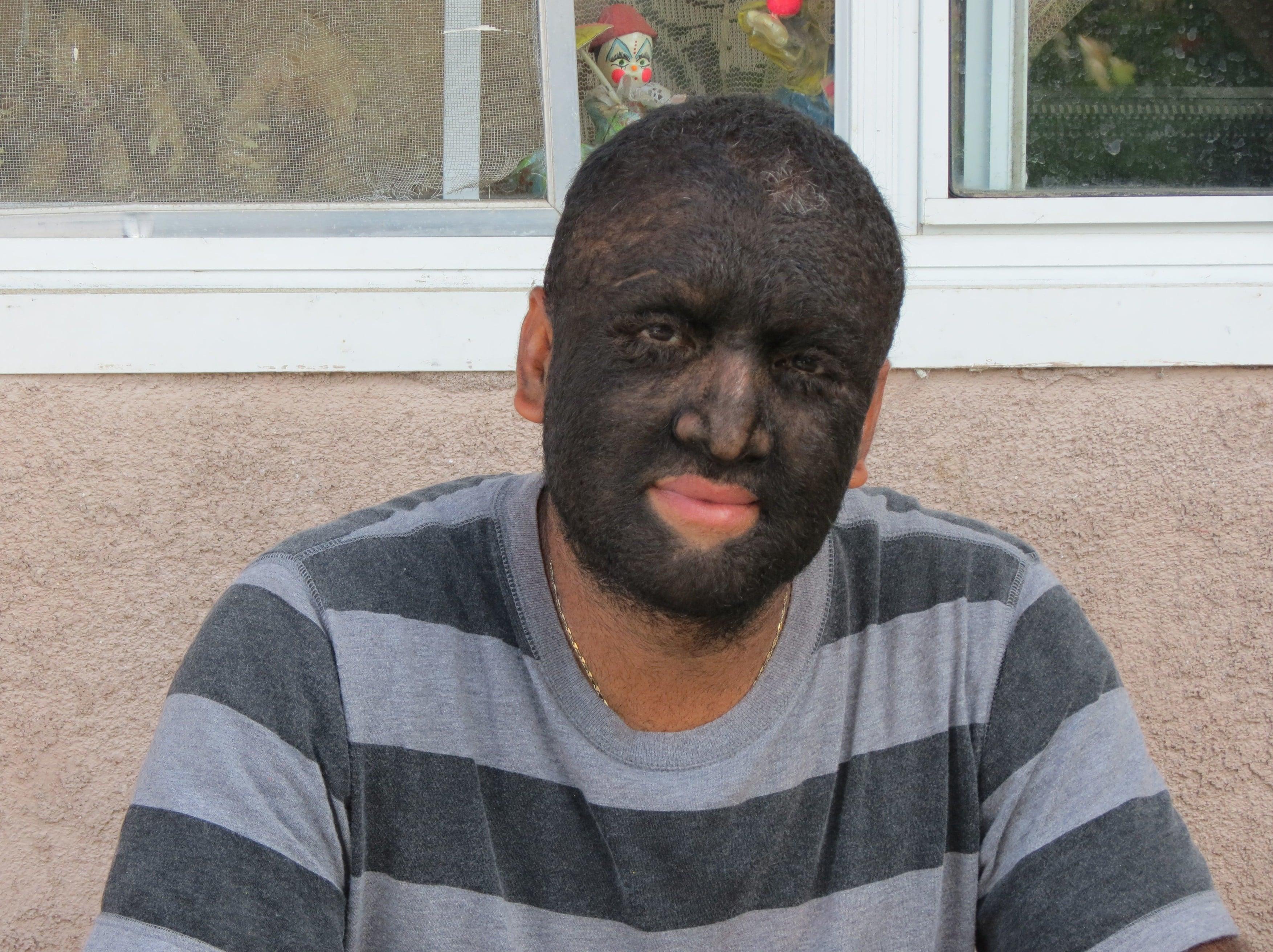 Gabriel Ramos Gomez a fost numit &rdquo;Bărbatul-lup&rdquo; pentru că are 95% din corp acoperit cu păr. De ce arată așa