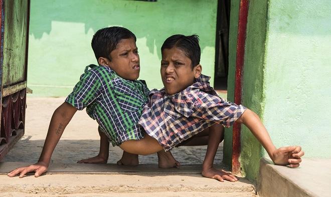 Ce s-a &icirc;nt&acirc;mplat cu gemenii siamezi Shivanath și Shivram Sahu, care au refuzat să fie despărțiți prin operație