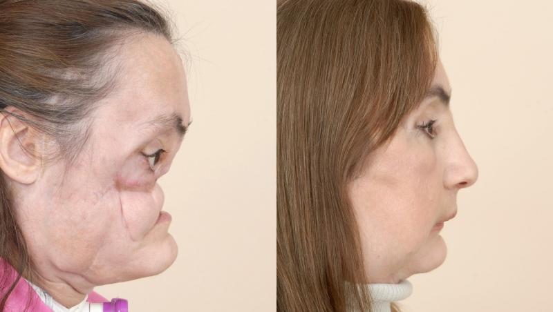 Connie Culp, înainte și după transplantul de față