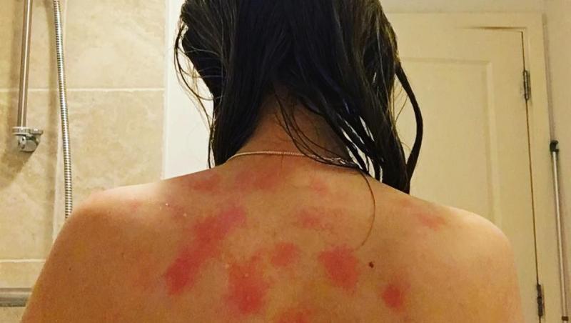 alergia pe care o face Lindsey Coubray, la contactul cu apa