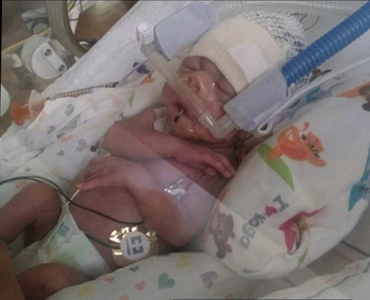 bebelușul născut prematur, având doar 600 de grame