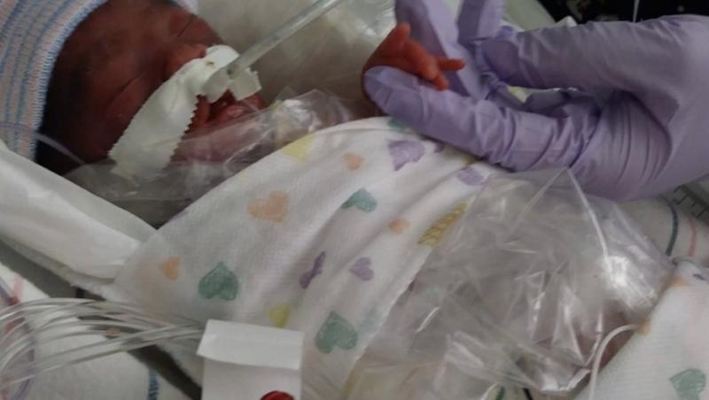bebelușul născut prematur, având doar 600 de grame