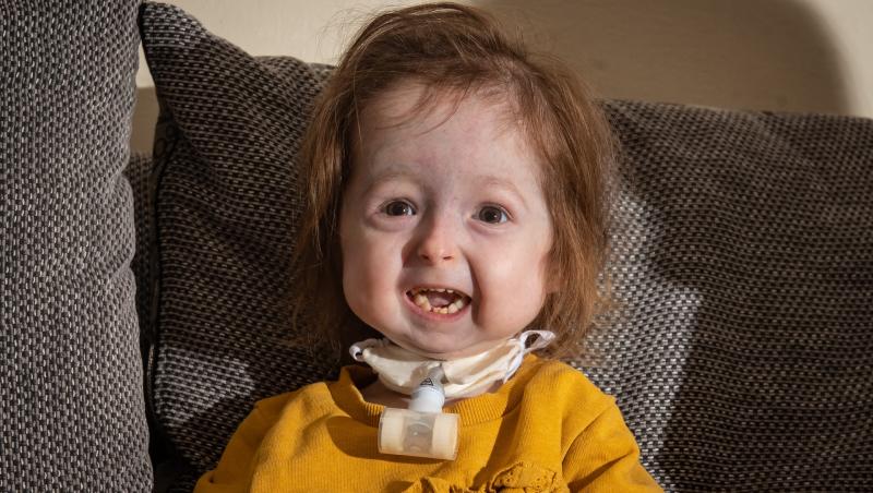 Isla Kilpatrick-Screaton e singura persoană din lume care a fost diagnosticată cu o mutație pe care familia sa o numește ”Benjamin Button”