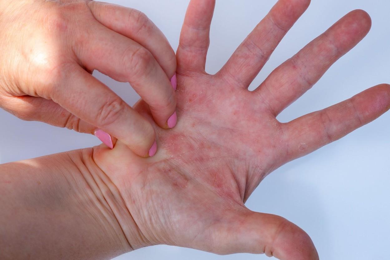 imagine cu maini ce prezintă erupții din cauza unei alergii