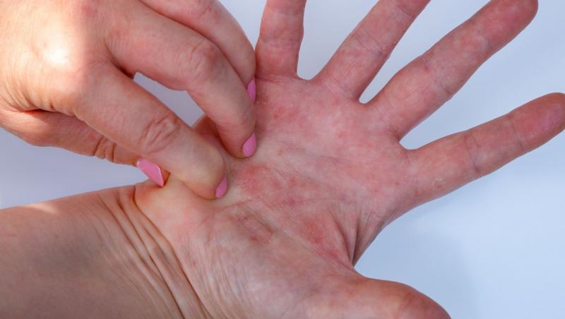 imagine cu maini ce prezintă erupții din cauza unei alergii