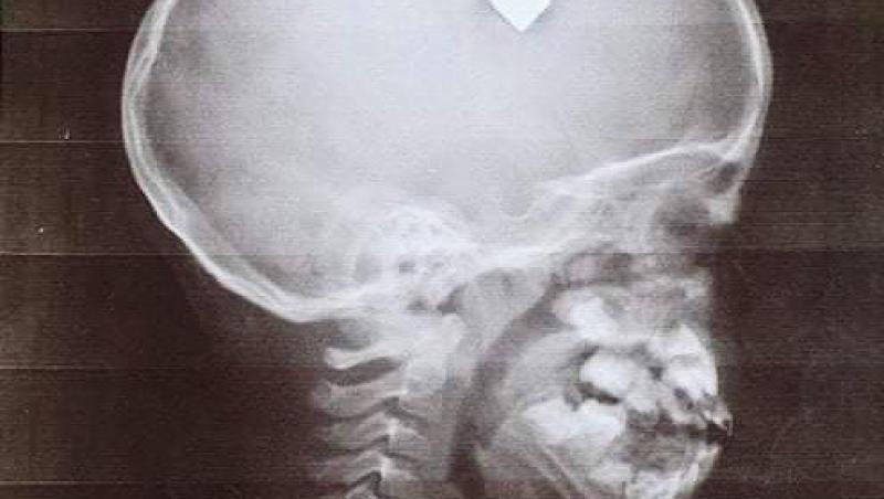 Medicii din Filipine au fost uluiți când au descoperit că băiatul are un glonț înfipt în cap