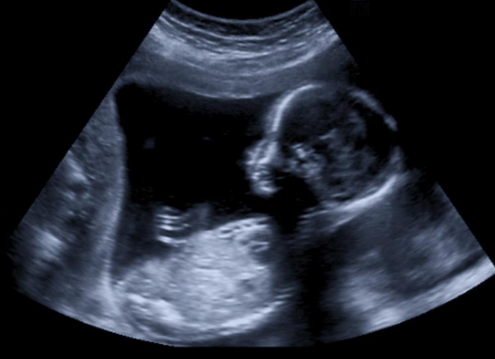 imagine cu ecografia unui bebelus