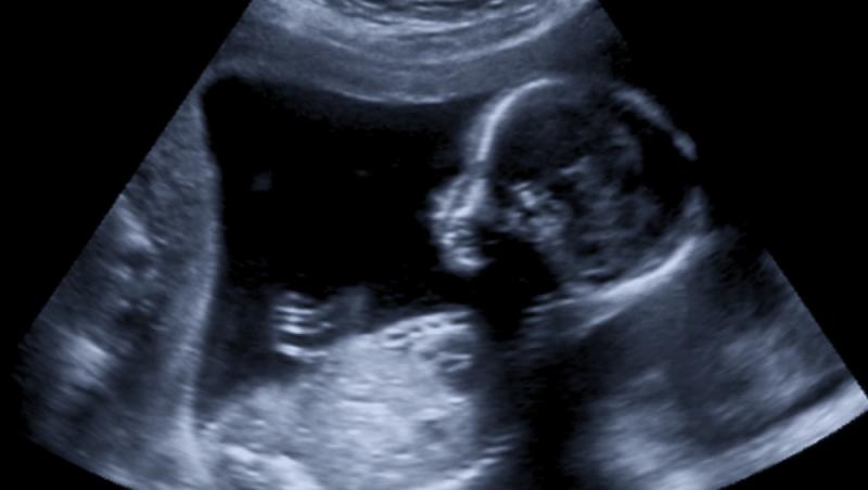 imagine cu ecografia unui bebelus