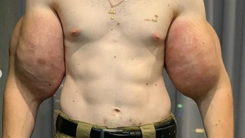 Medicii i-au dat lui Kiril un avertisment: dacă nu își scoate de tot implanturile, va rămâne fără brațe sau chiar va muri