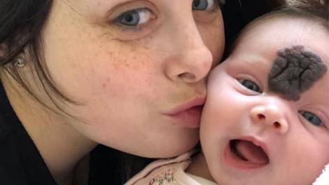Vienna s-a născut cu un nev congenital non-neoplazic. Care a fost reacția doctorilor când au văzut semnul de pe fruntea ei