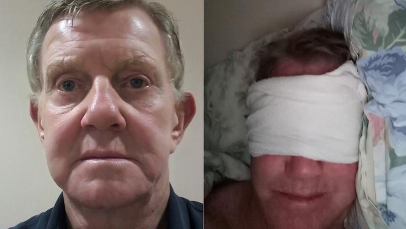 Pete Broadhurst, un bărbat din Londra în vârstă de 79 ani, a apelat la o intervenție estetică ce i-a afectat vederea. Operația a eșuat, iar rezultatul a fost unul devastator.