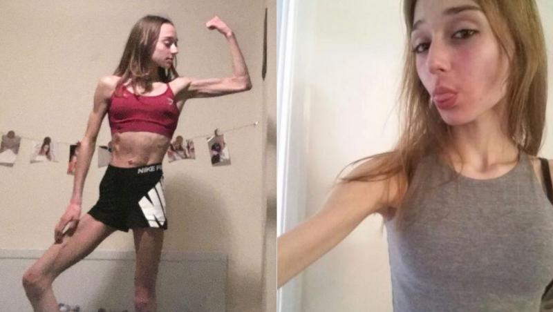 Scarlett Wilson, o tânără în vârstă de 20 ani din Northamptonshire, Marea Britanie, s-a confruntat toată viață cu anorexia, boală ce o făcuse să fie extrem de slabă.