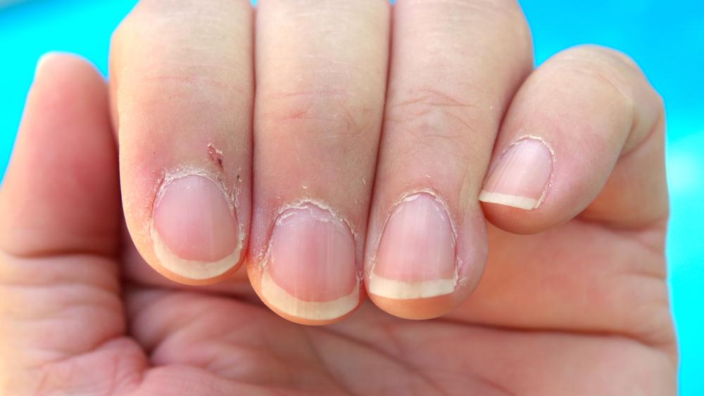 theme mate pin De ce sunt atât de dureroase pielițele de la unghii și cât de periculos  este să le rupi | Antena 1