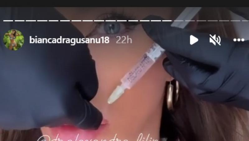 Cum arată Bianca Drăgușanu după ce a avut parte de o procedură de topire a acidului din buze: „Nici nu mă așteptam”