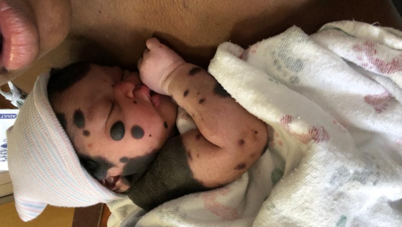 Jireh s-a născut, spre surprinderea medicilor, cu o mulțime de pete negre pe corp. Ce sunt semnele care îi acoperă pielea