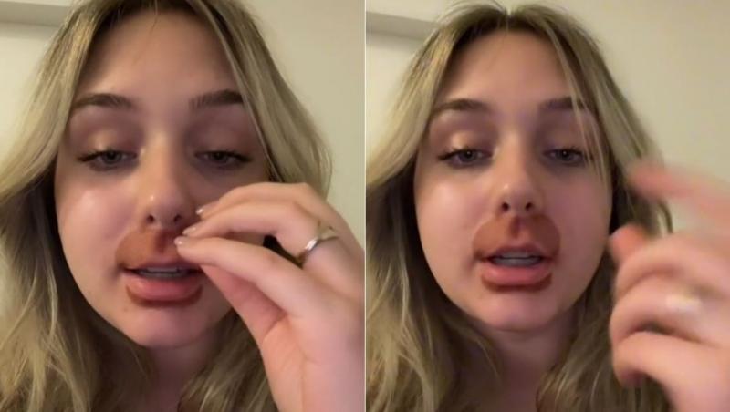 Jade Davis a decis să facă procedura cosmetică „lip flip” pentru a-și face buzele să pară mai mari și mai voluminoase, îndepărtând în același timp ridurile din jurul gurii.