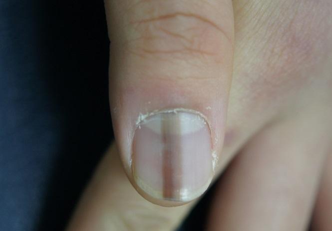 O tânără a văzut că are o linie dreaptă și maro pe unghie. Când a mers la spital, medicul i-a dat vestea ce i-a schimbat viața