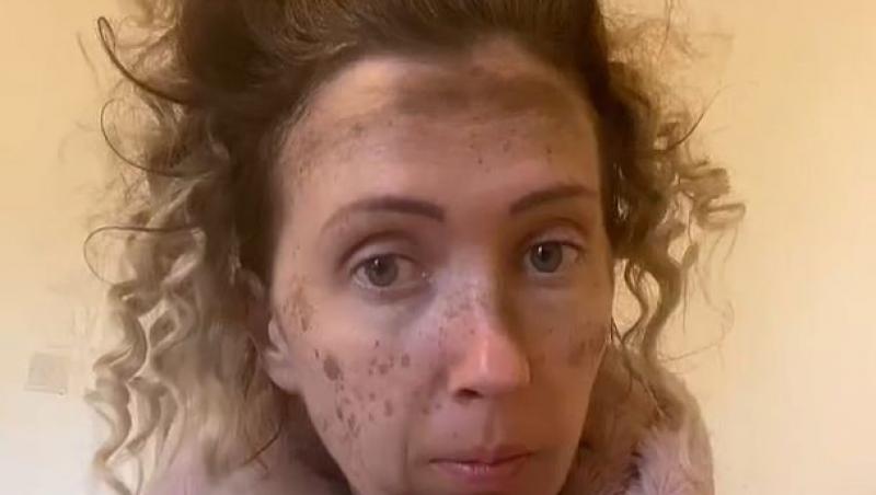 Femeia și-a dorit un nou look, dar procedura la care a apelat a dat greș și a lăsat-o cu pete mari pe față. Ce s-a întâmplat