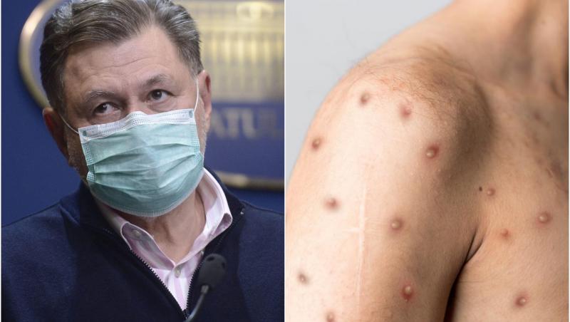 Pe 14 iunie, Ministerul Sănătății a anunțat cel de-al doilea caz de variola maimuței înregistrat pe teritoriul României, în doar 24 de ore.
