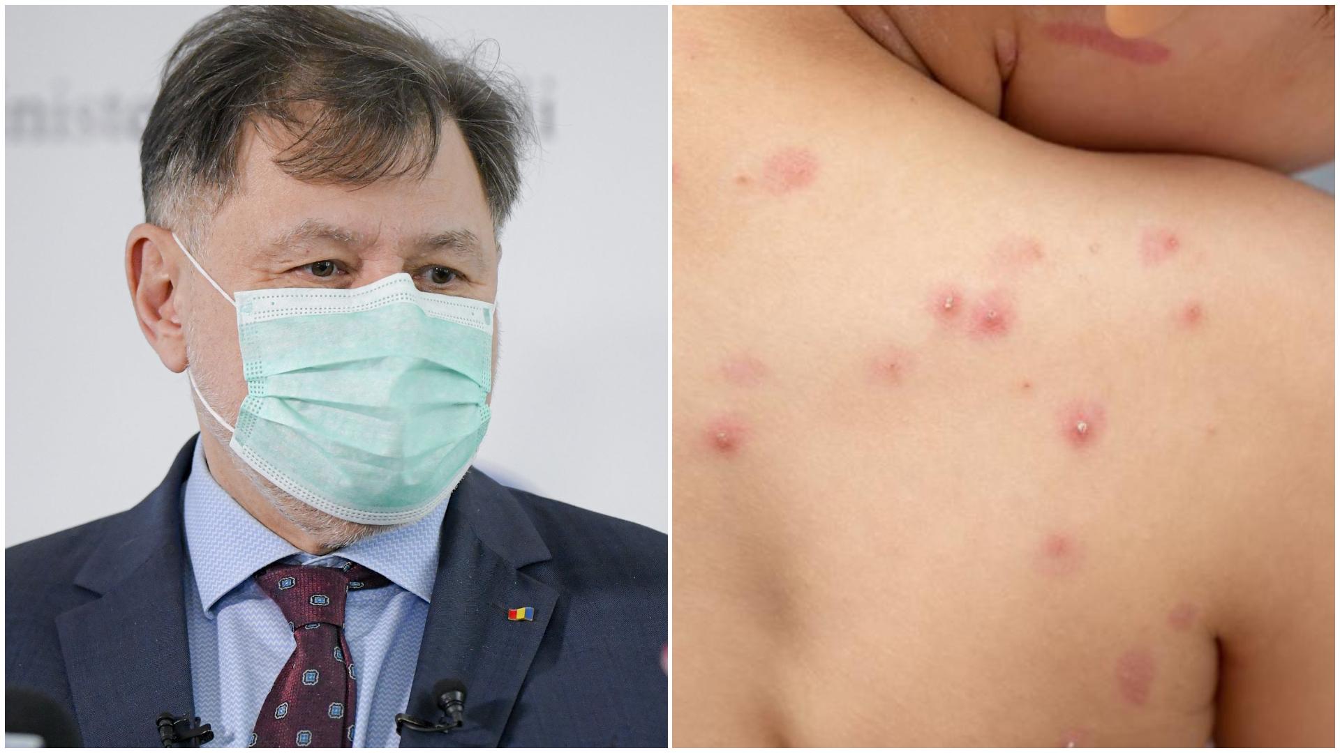Alexandru Rafila, lămuriri referitoare la variola maimuței. Ce trebuie să evite românii, după cazurile descoperite la noi în țară