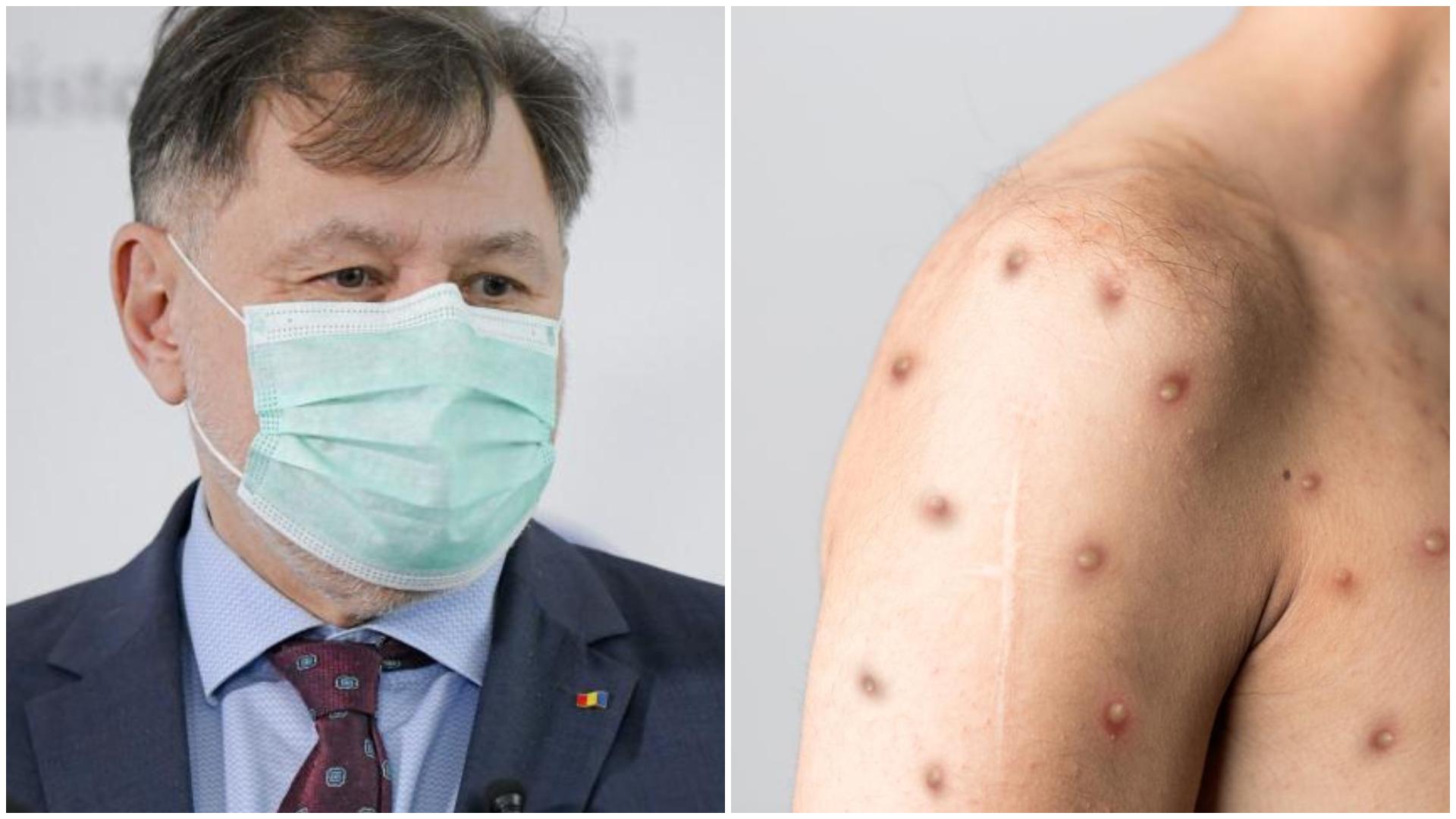 Un nou caz de variola maimuței a fost depistat în România. Câte cazuri au fost înregistrate până acum la noi în țară