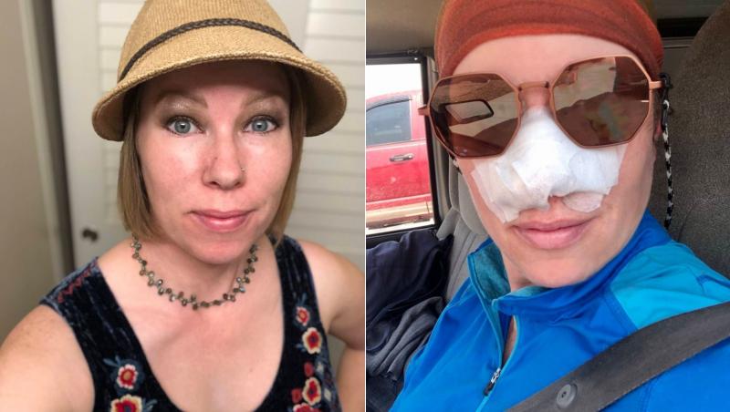 Melissa Fife, o femeie în vârstă de 40 ani, s-a ales cu o cicatrice pe nas în urma unui coș care i-a dat mari bătăi de cap. Cicatricea a dus la consecințe grave care i-au agravat starea de sănătate.