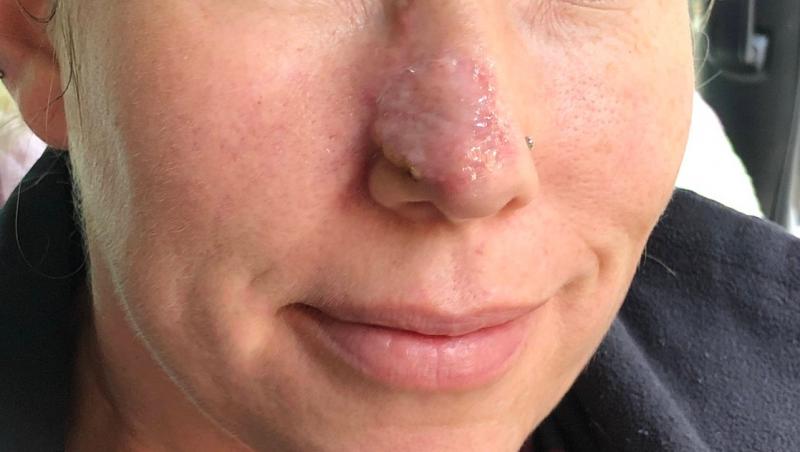 Femeia avea un furuncul banal pe nas, dar situația a scăpat de sub control. Medicii au luat o decizie drastică. Ce a pățit