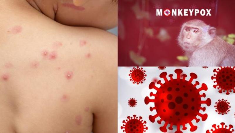 Lista persoanelor care pot fi afectate de variola maimuței a crescut. OMS anunță cine riscă să ia această boală și cât de repede