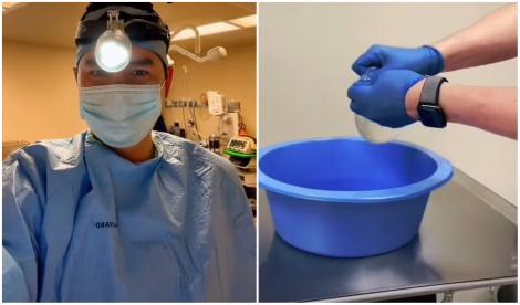Ce a găsit un medic atunci când a scos un implant mamar de silicon, vechi de 30 de ani. Filmarea a devenit virală pe TikTok