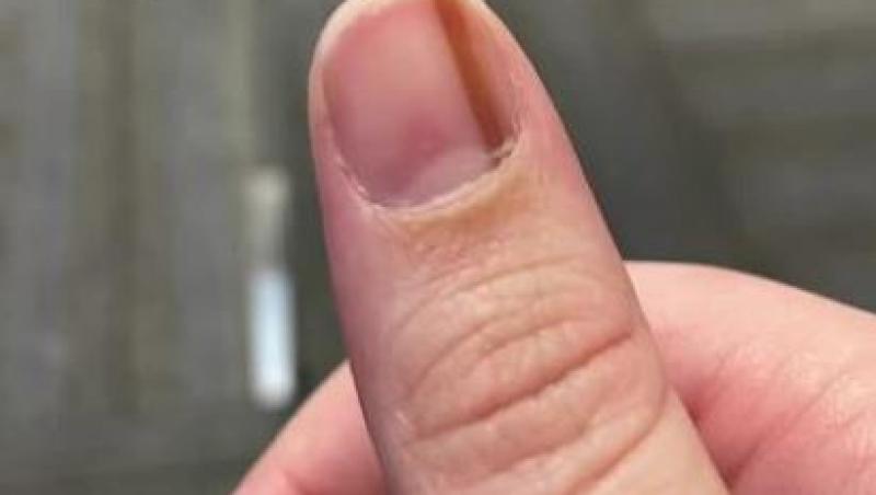 Această femeie avea o linie pe unghie și nu i-a dat atenție timp de 10 ani. Nu i-a venit să creadă ce boală gravă o provoca