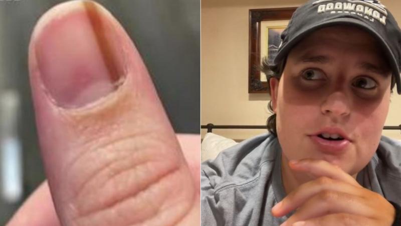 O femeie a fost devastată să afle adevăratul motiv pentru care avea o dungă pe unghie. De 10 ani de zile, ea observase semnul, însă nu i-a acordat atenție. Acum regretă și spune că ar fi trebuit să ia măsuri mai devreme.