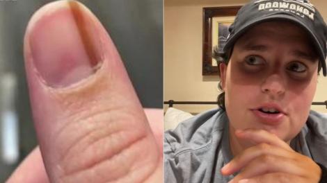Această femeie avea o linie pe unghie și nu i-a dat atenție timp de 10 ani. Nu i-a venit să creadă ce boală gravă o provoca