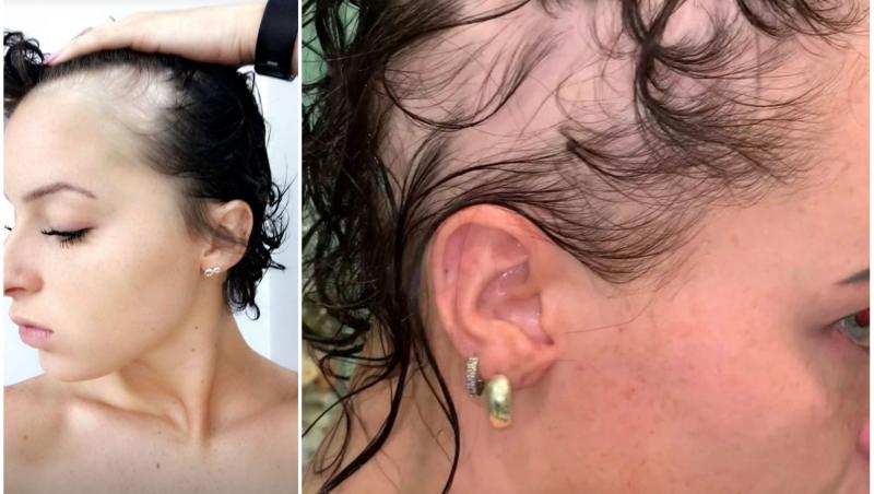Povestea tinerei care suferă de alopecie a devenit virală și a stârnit numeroase reacții în mediul online